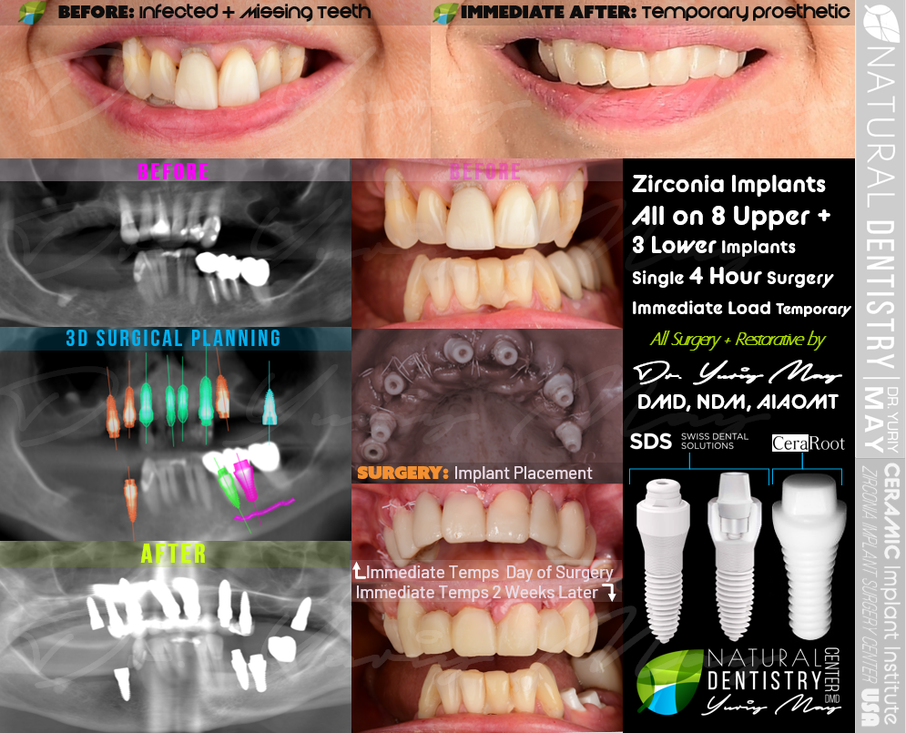What is the best age for dental implants?