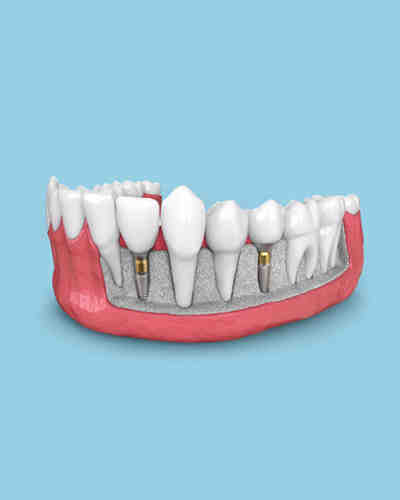 What is the best age for dental implants?