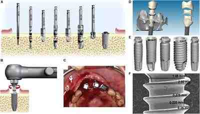 What is the best alternative to dental implants?
