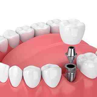 What is the best alternative to dental implants?
