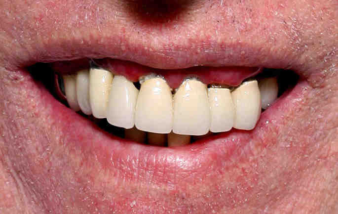 What is the best alternative to dental implants?