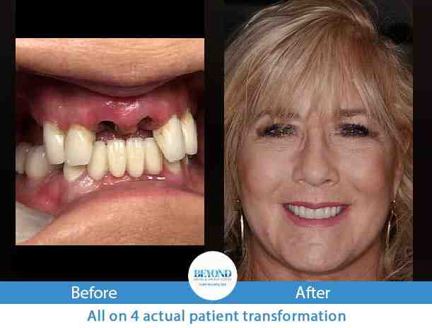 What is the best alternative to dental implants?