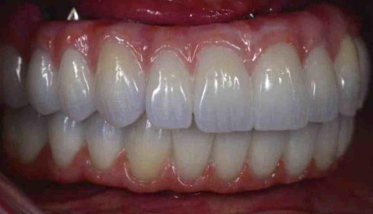 What is the best material for dental implants in 2018