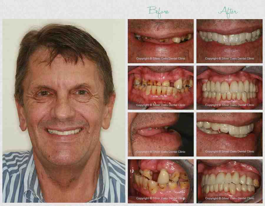 What is the cheapest way to replace one tooth?