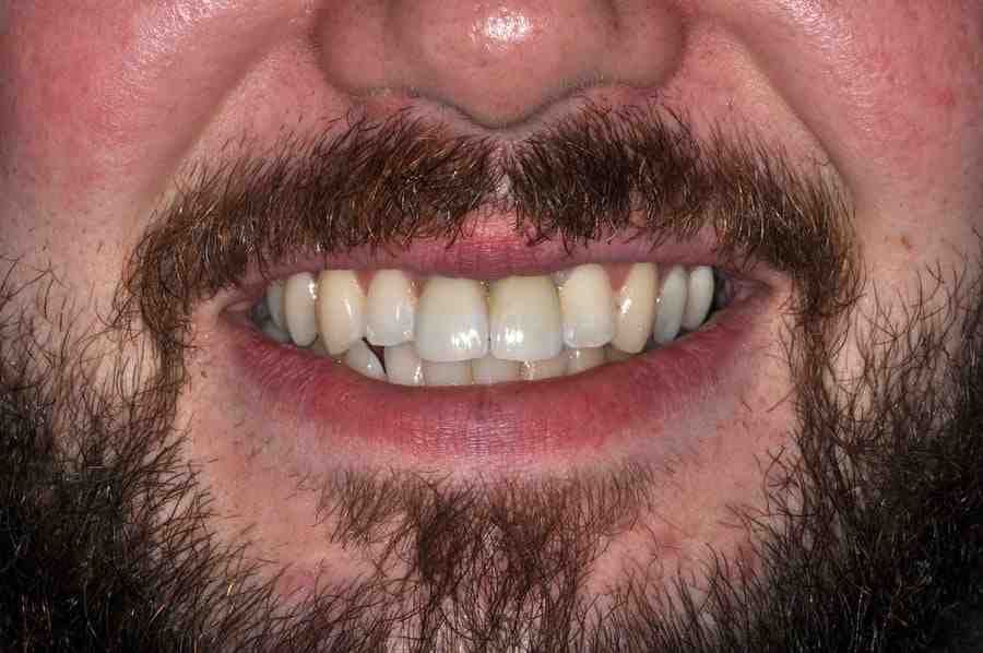What is the cost of a zirconia implant?