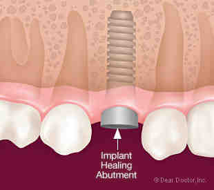 What is the difference between an implant and an abutment?