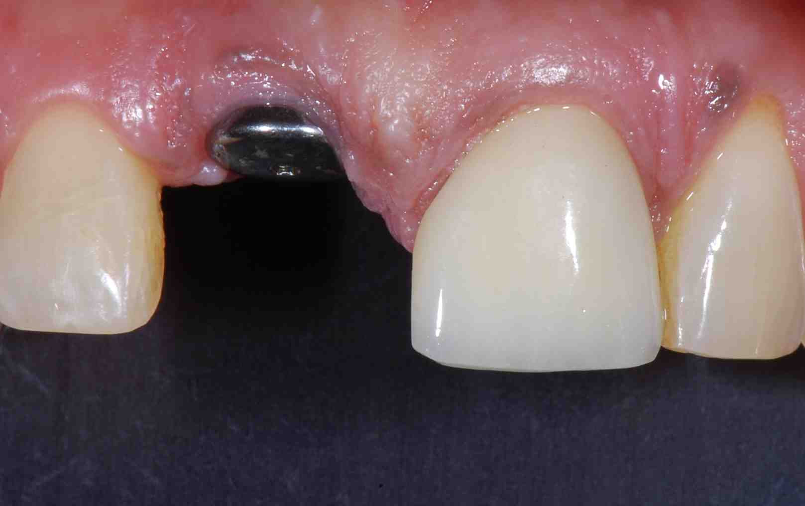 What is the difference between endosteal and Eposteal implants?