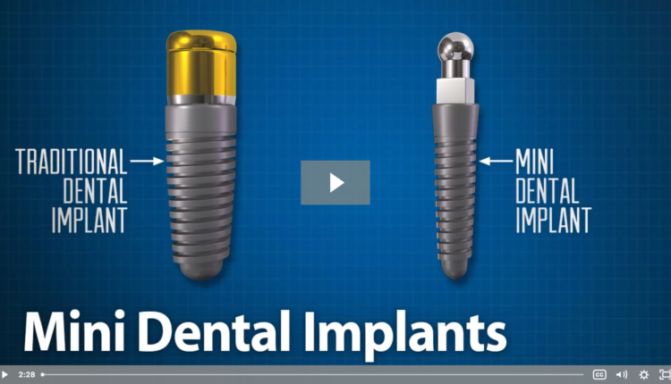 What is the difference between mini dental implants and regular implants