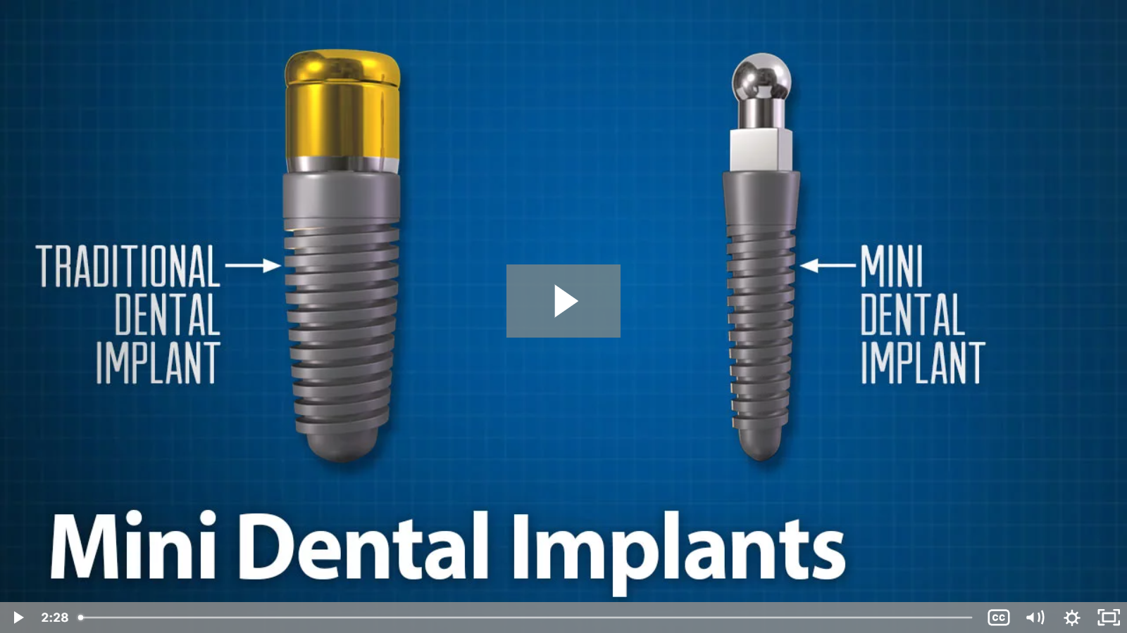 what-is-the-difference-between-mini-dental-implants-and-regular