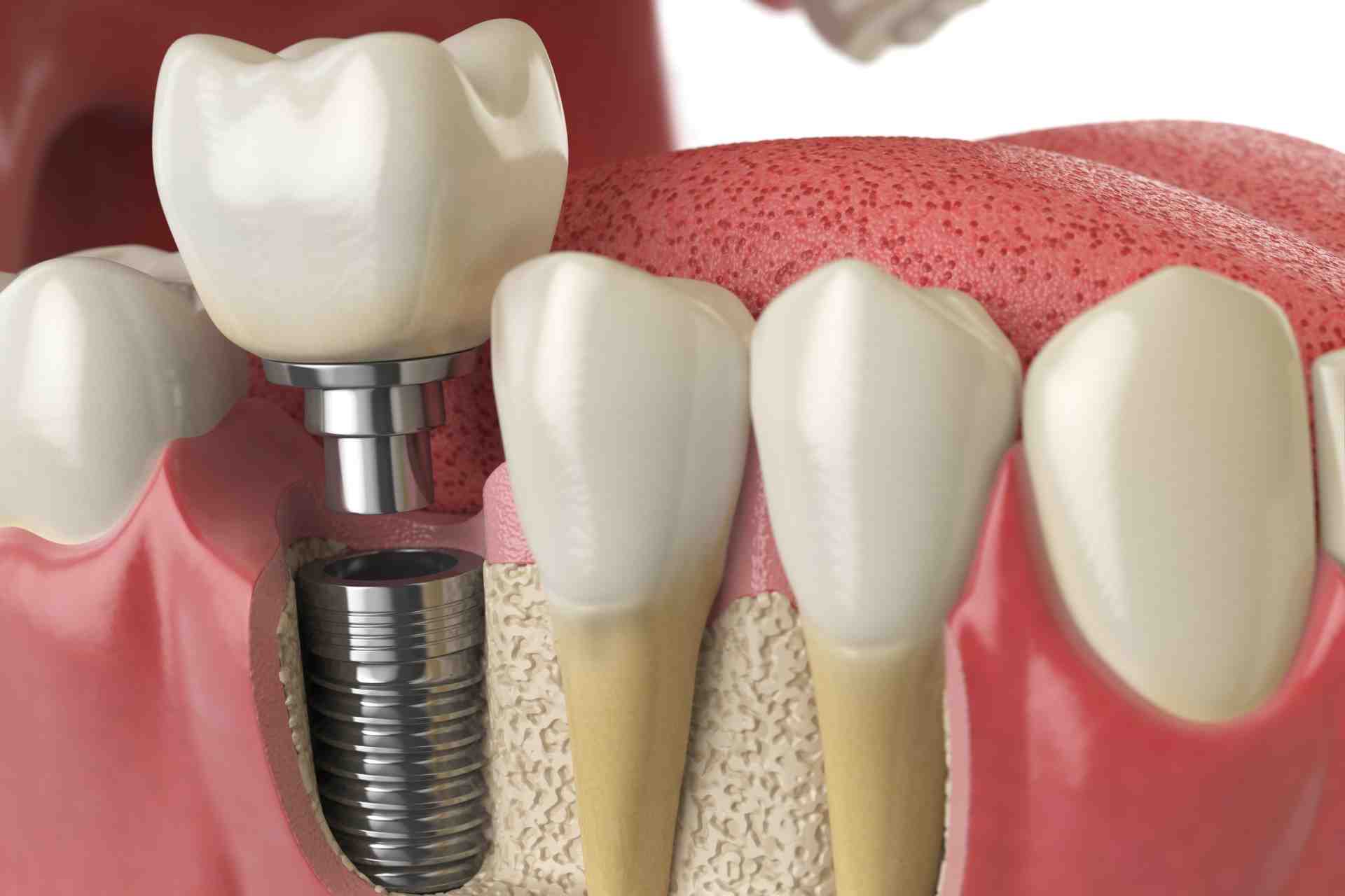 What is the difference between mini implants and implants?