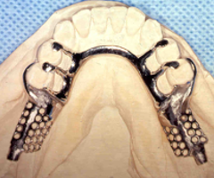 What is the difference between titanium and zirconium implants?