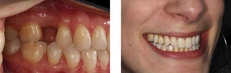 What is the downfall to dental implants?