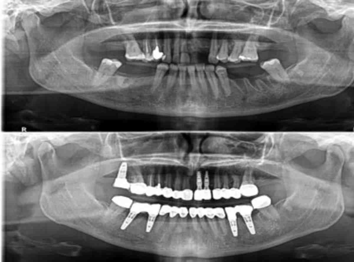 What is the downfall to dental implants?