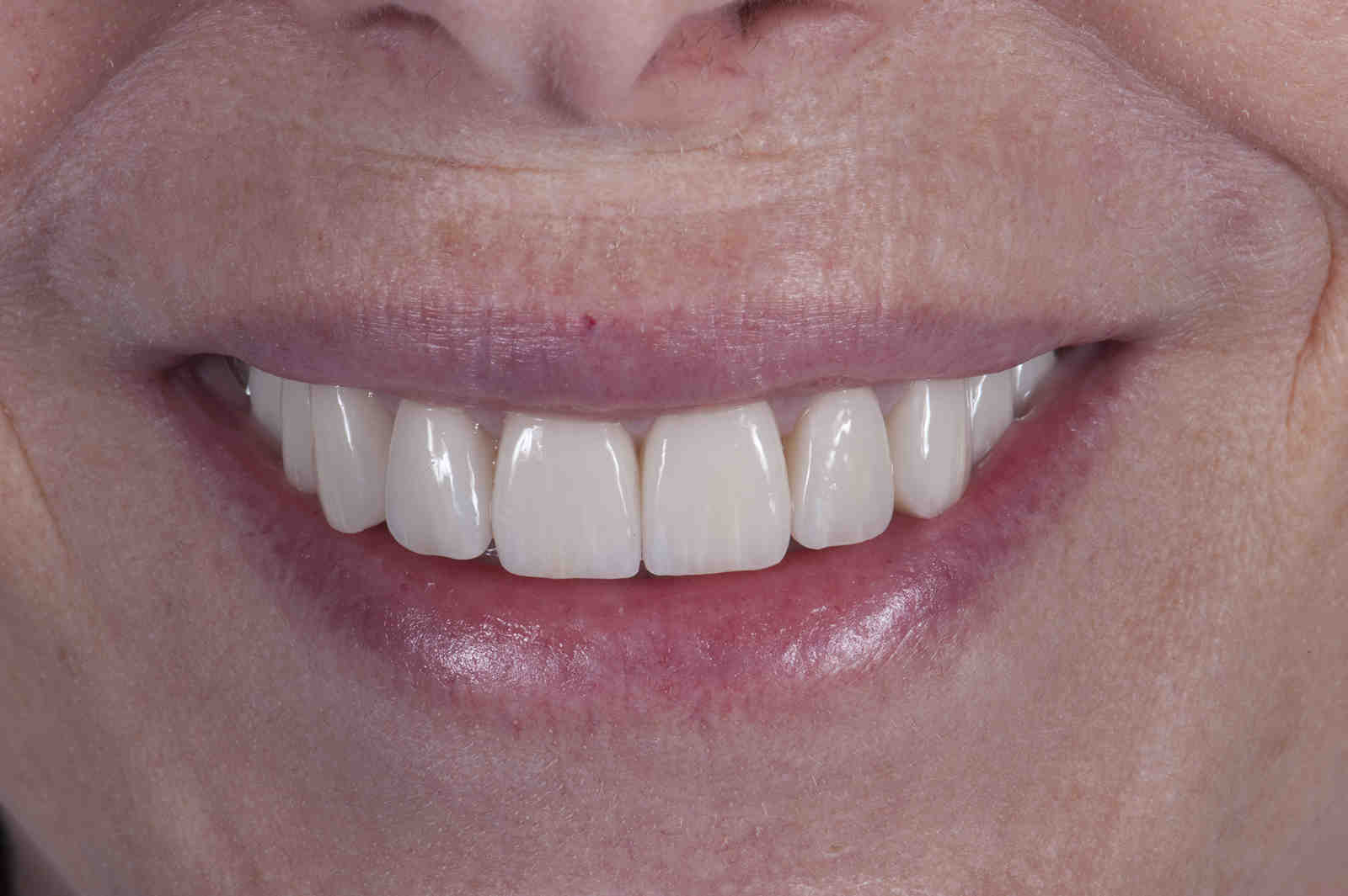 What is the downfall to dental implants?