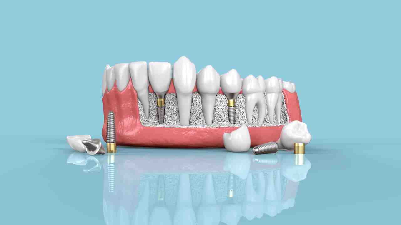 What is the downside of dental implants?