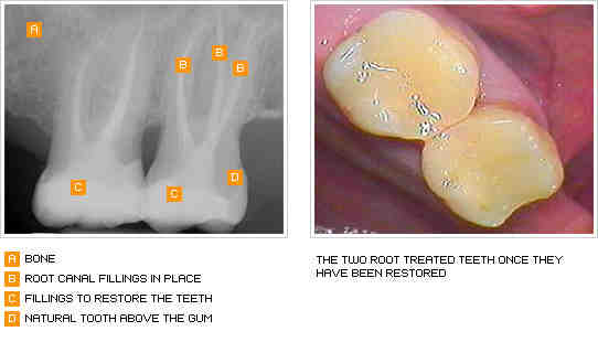What is the downside of dental implants?
