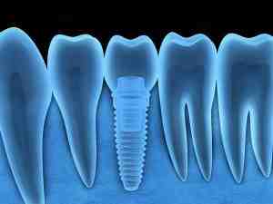 What is the downside of dental implants?