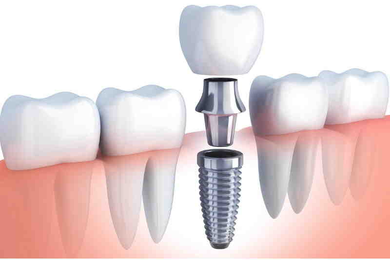 What is the downside of dental implants?