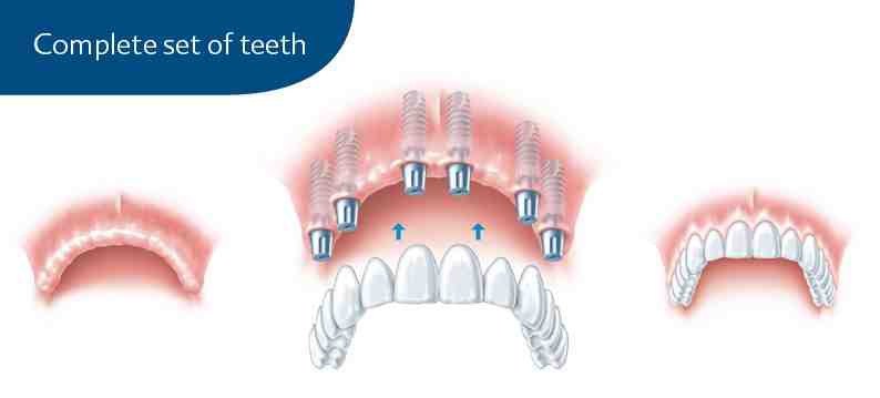 What is the downside of dental implants?