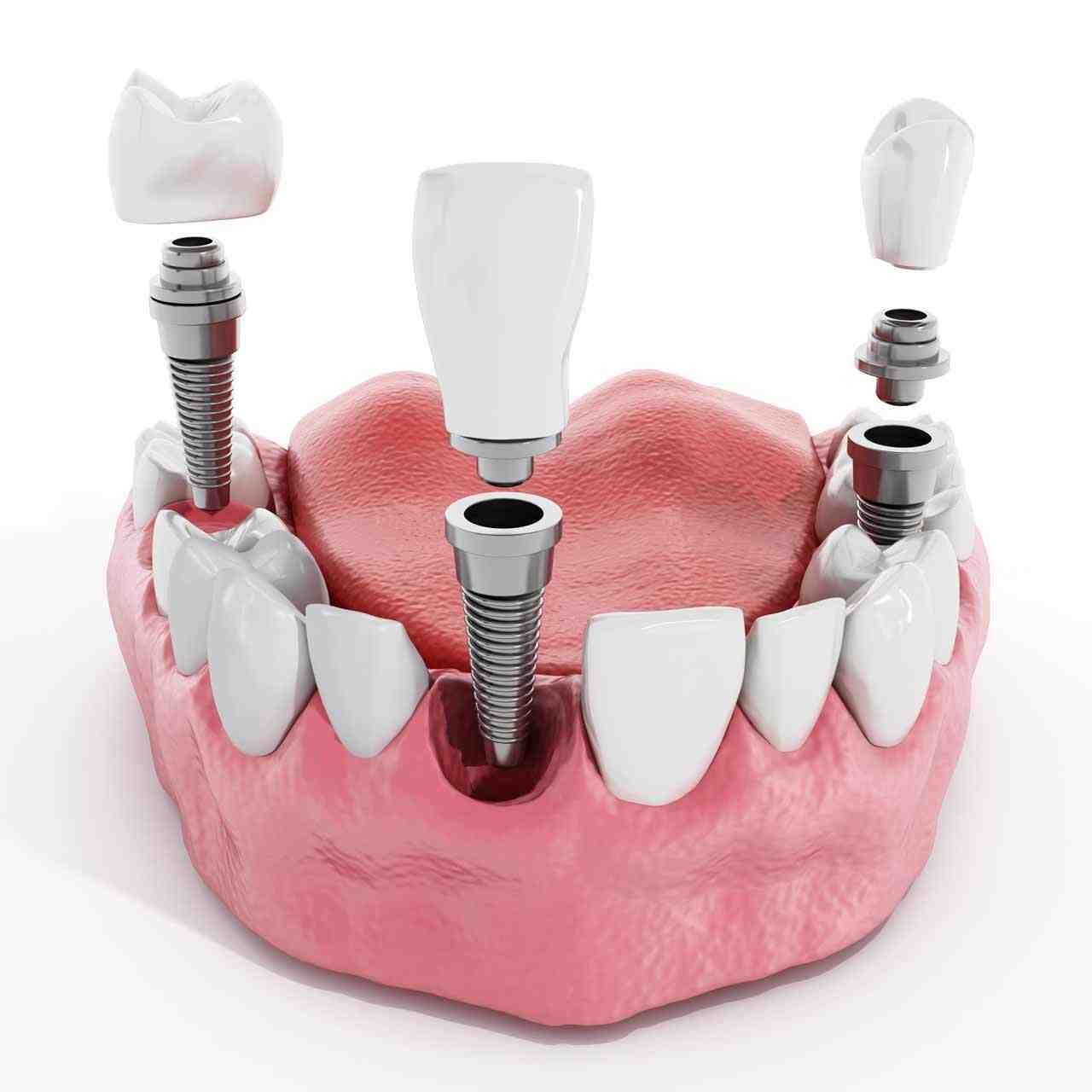 What is the downside of dental implants?