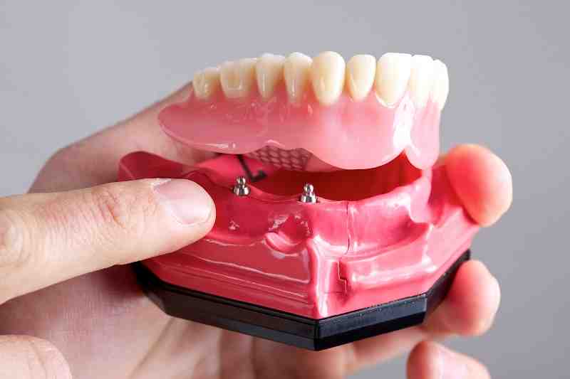 What is the downside of dental implants?
