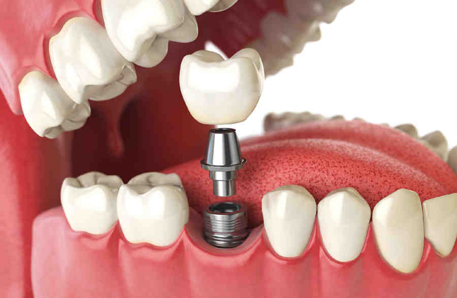 What is the downside of dental implants?