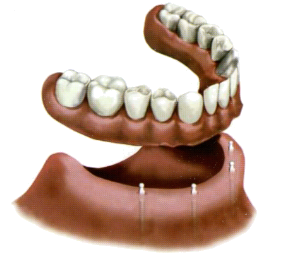 What is the downside of mini dental implants?