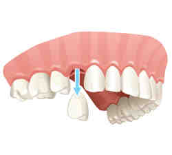 What is the downside to dental implants?