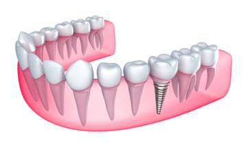 What is the downside to dental implants?