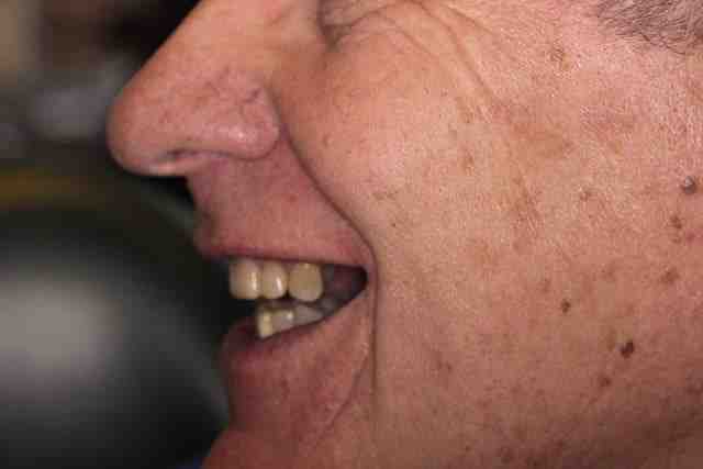 What is the failure rate for dental implants?