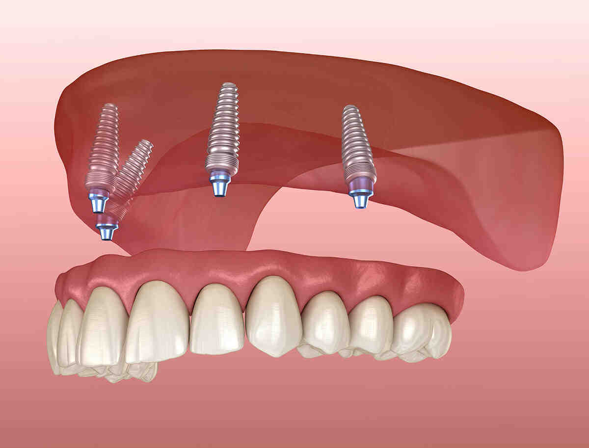 What is the failure rate for dental implants?