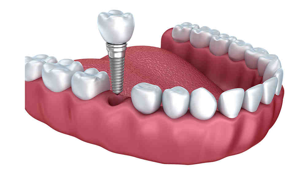 What is the failure rate for dental implants?