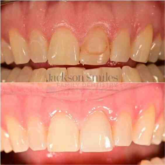 What is the failure rate of Mini dental implants?