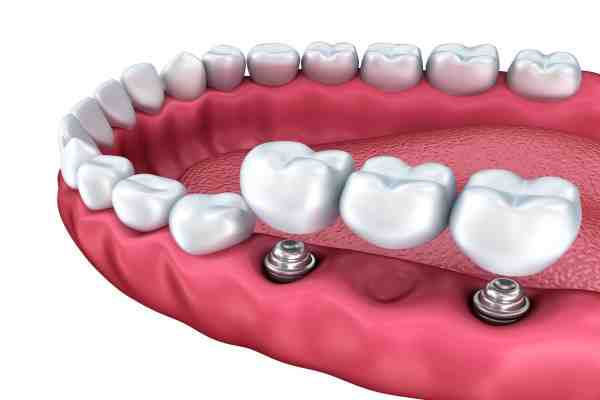 What is the failure rate of dental implants?