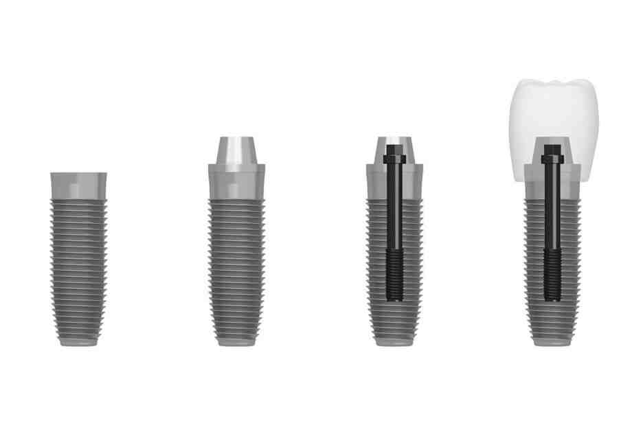 What is the last step of the implant procedures?