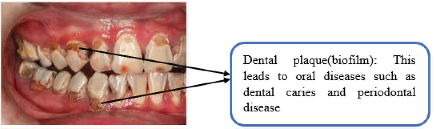 What is the latest technology for dental implants?