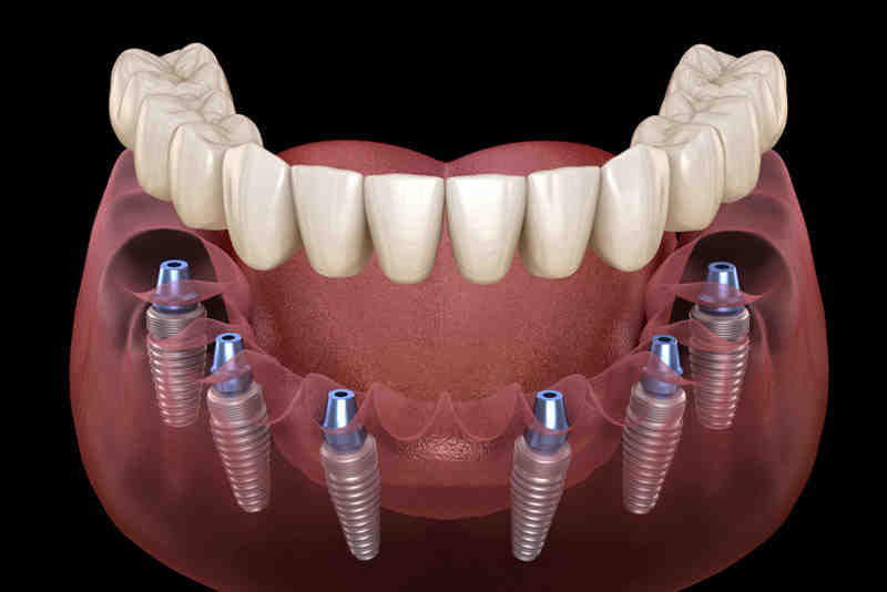What is the latest technology for dental implants?