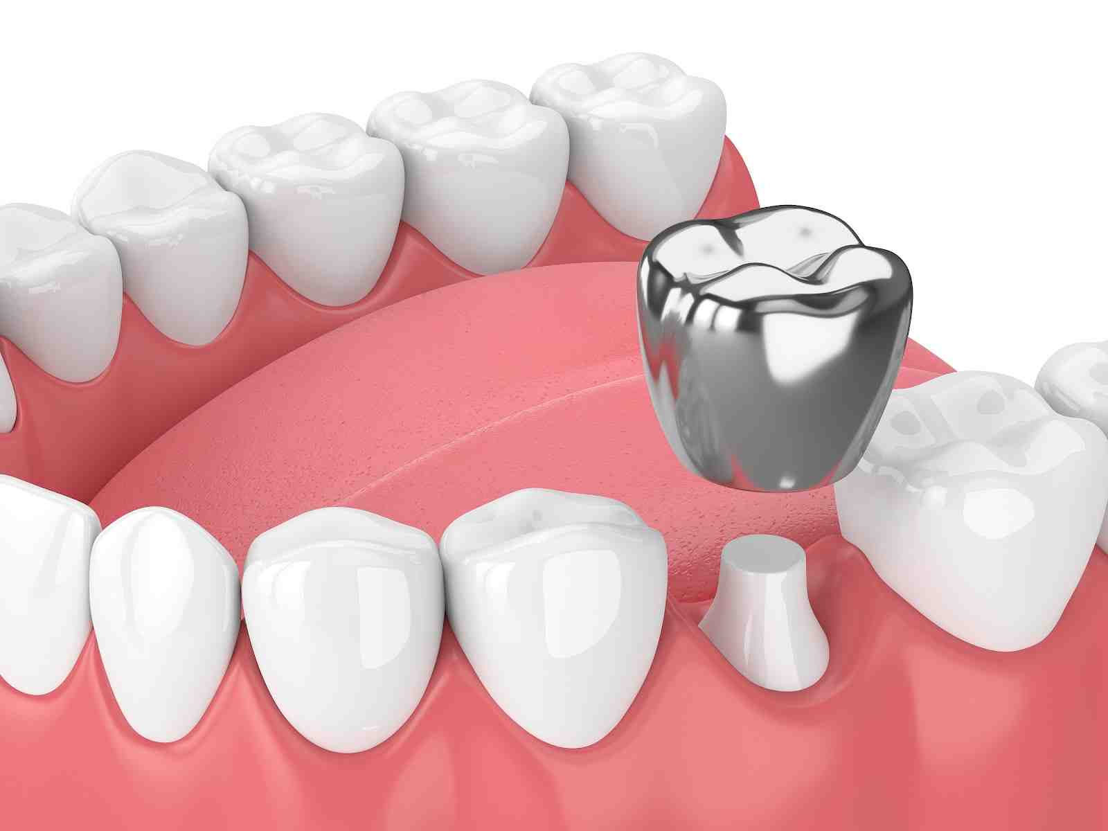 What is the lifespan of a dental implant?