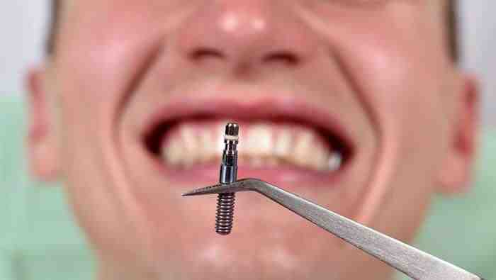 What is the lifespan of dental implants?