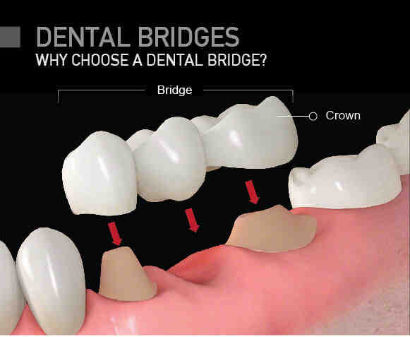 What is the medical code for a dental implant?