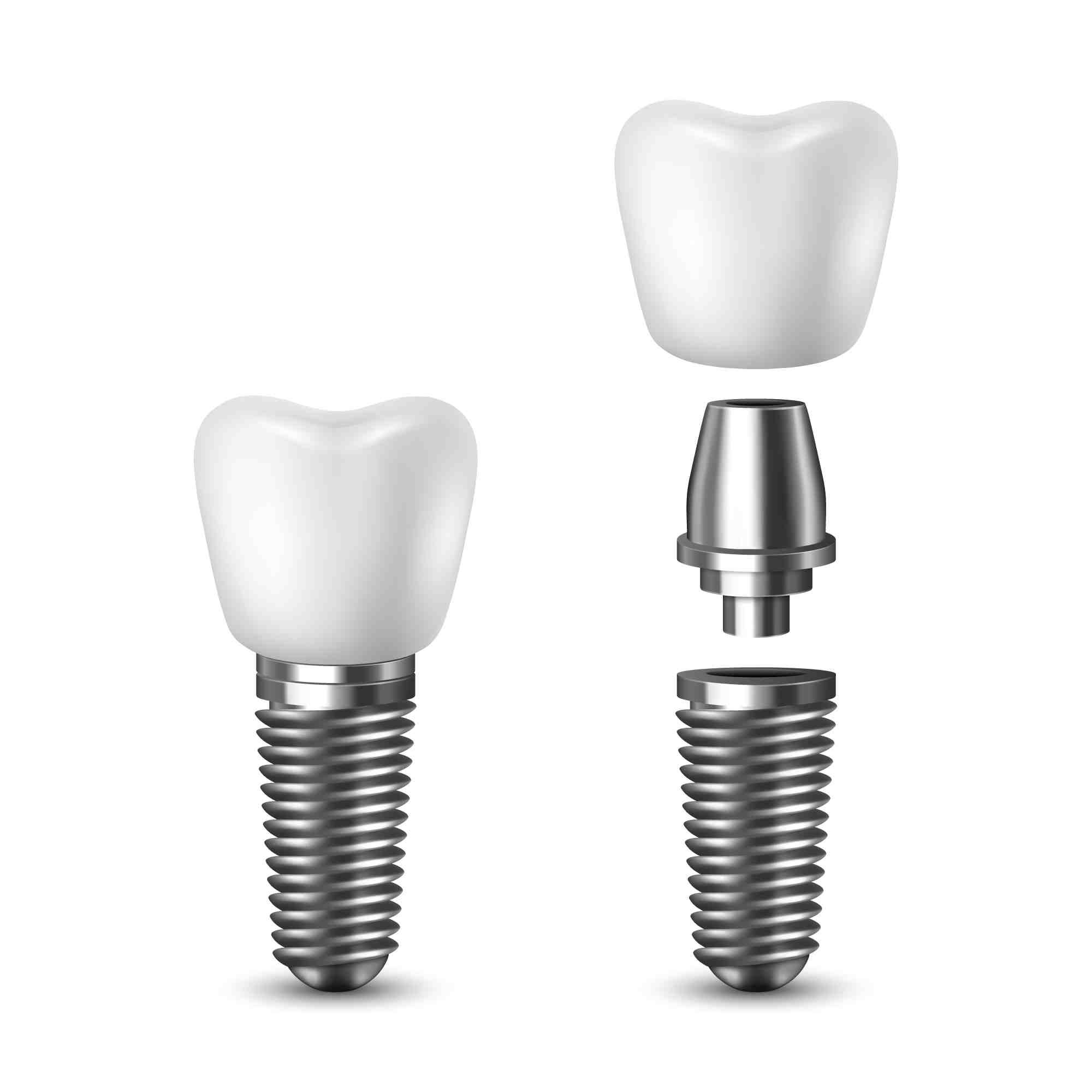 What is the newest technology for dental implants?