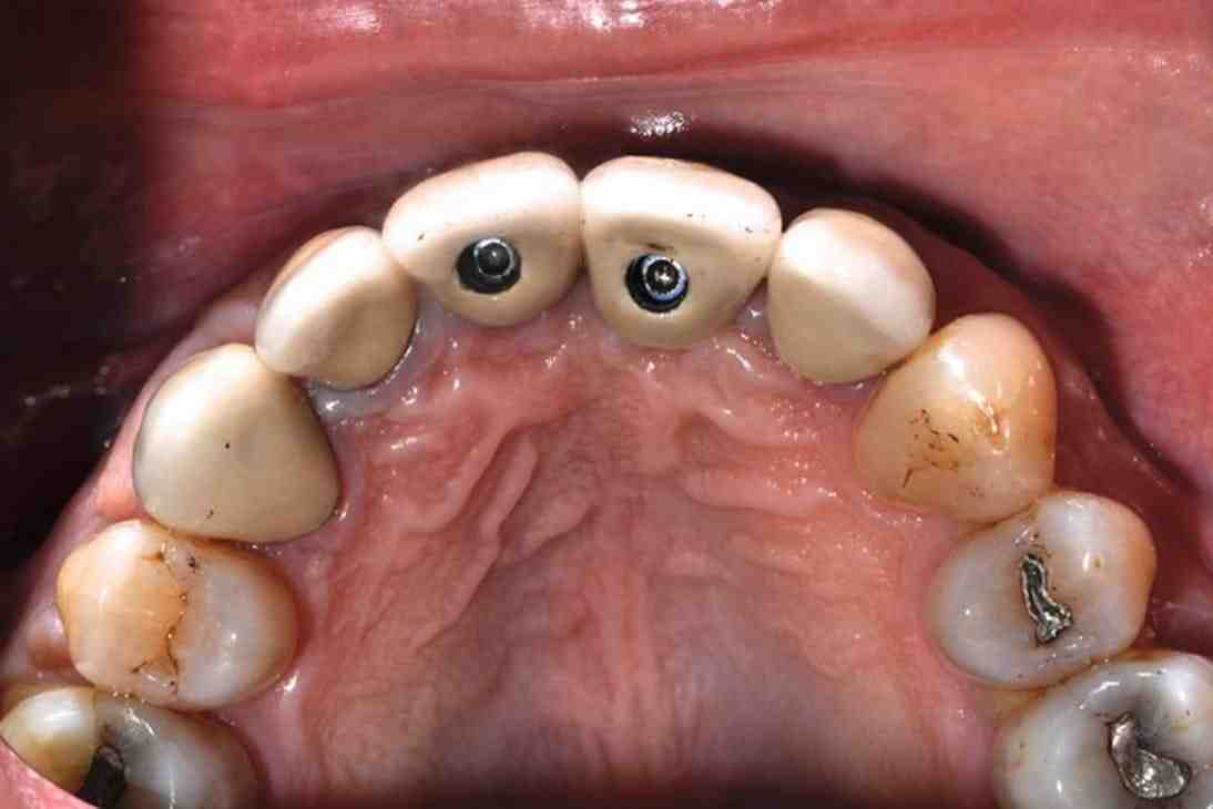 What is the screw called in an implant?