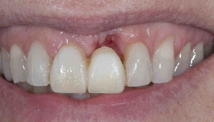 What is the success of bone grafts before dental implants