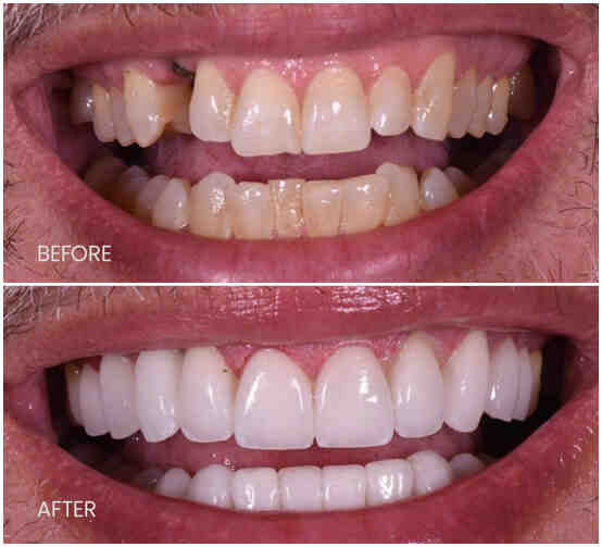 What is the success rate of dental implants?