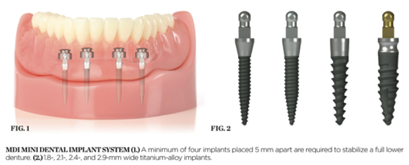 What is the success rate of mini implants?