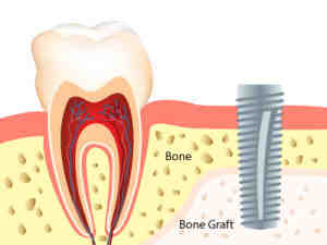 What kind of bone is used in dental implants?