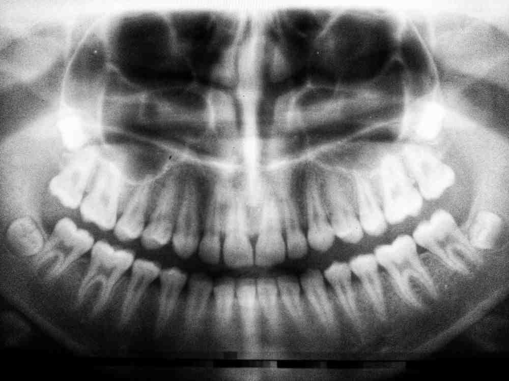 What makes dental implants medically necessary?