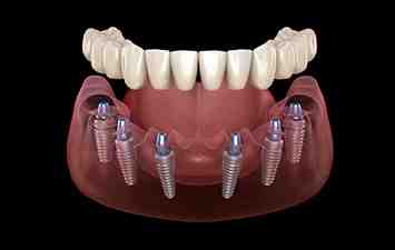 What makes dental implants medically necessary?