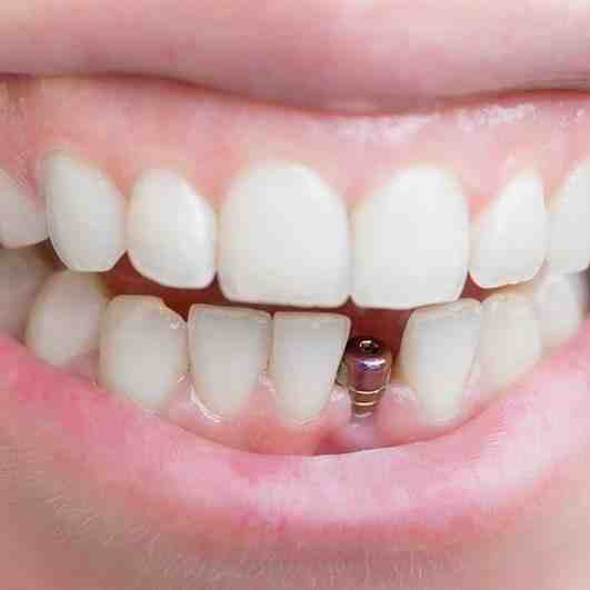 What not to do with teeth implants?