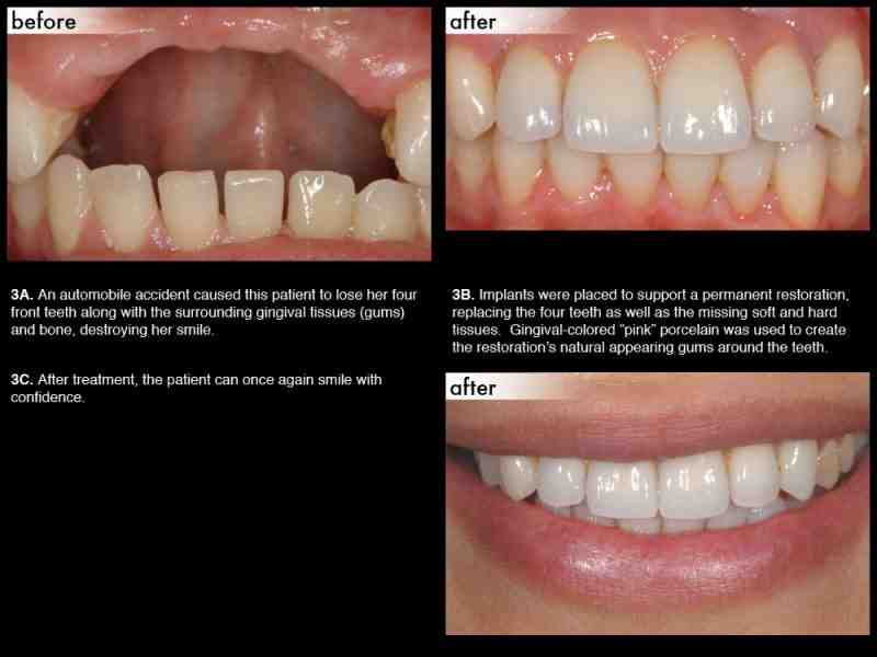 What percentage of dental implants are titanium?